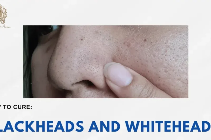 How to Get Rid of Blackheads and Whiteheads: Ultimate Guide