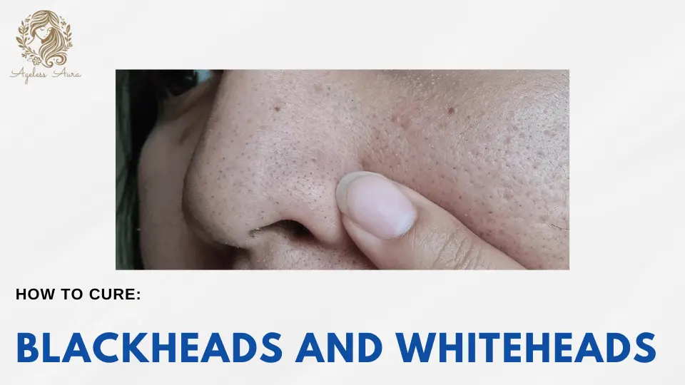 Blackheads and Whiteheads
