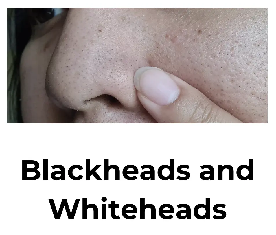 Blackheads and Whiteheads
